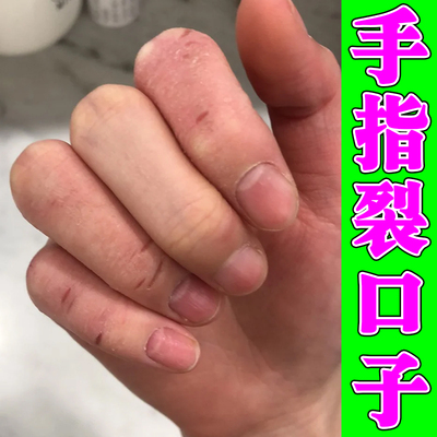 手指裂口子干裂疼痛手开裂干燥粗糙手裂的药脚后跟干裂修复霜膏