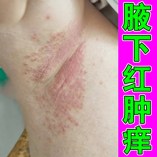 腋下红肿痒长小红点疙瘩腋窝淹红胳肢窝出汗刺挠皮肤过敏外用软膏