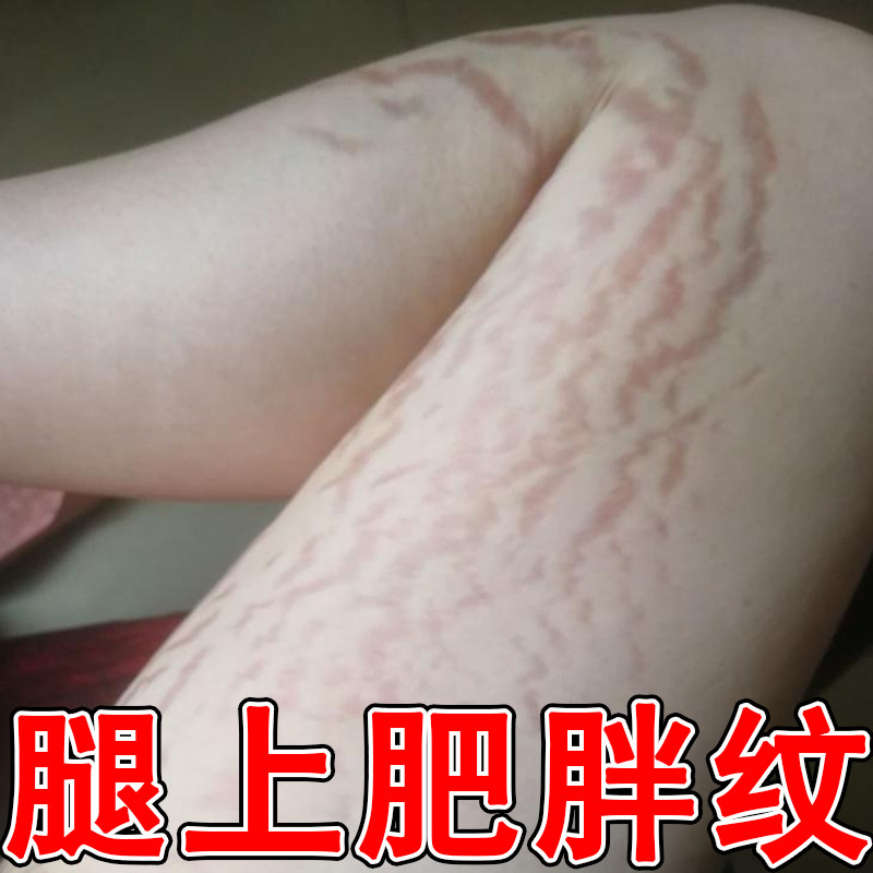 消大腿学生专用淡化纹路祛肥胖纹皮肤消毒护理（消）