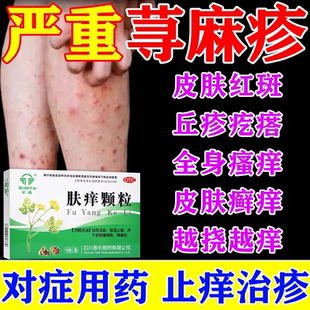 荆肤痒颗粒正品断治疗寻荨麻疹过敏皮肤瘙痒止痒根特用效中药调理