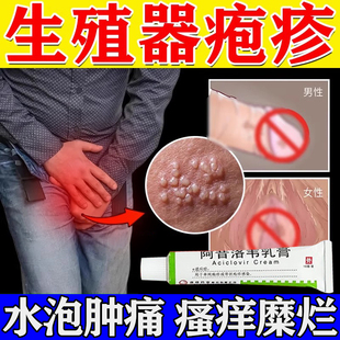 生殖器带状汗疱疹药膏男女下体私处瘙痒糜烂真菌感染阿昔洛韦乳膏