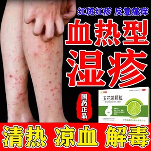 五花茶颗粒血热湿疹皮肤痒湿疹止痒去它根血热凉血茶解毒清热