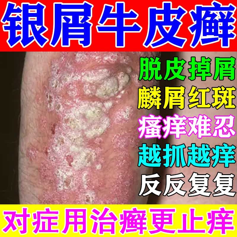 治牛皮癣口服药皮肤瘙痒反复发作红肿脱屑治癣银屑病皮炎专用中药