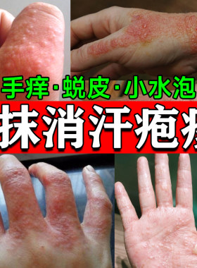 【意比舒】曲安奈德益康唑乳膏20g*1支/盒