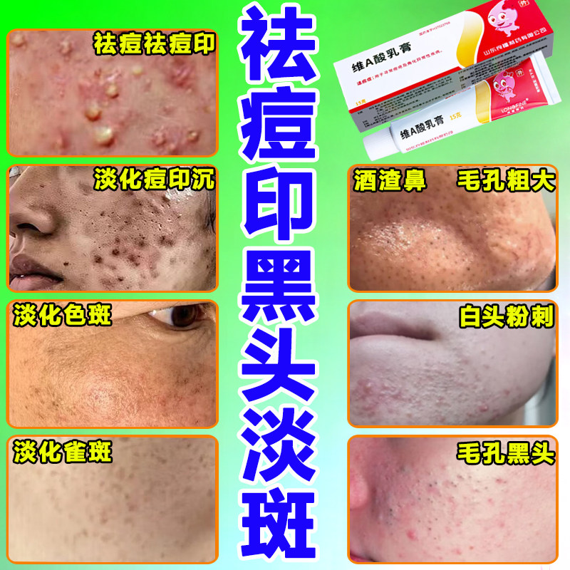 去黑头祛斑淡化色斑祛痘印收缩毛孔粉刺专用维aA酸乳膏医用去痘印
