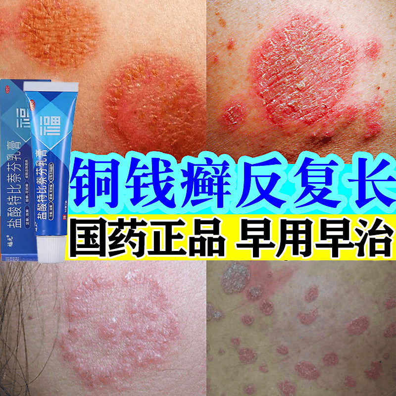 铜钱癣体癣专用药膏真菌感染皮肤干燥瘙痒全身癣痒去外用止痒抑菌