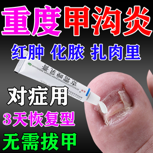 甲沟炎治疗专用药膏指甲长肉里消炎消肿化脓大拇指嵌甲克霉唑乳膏