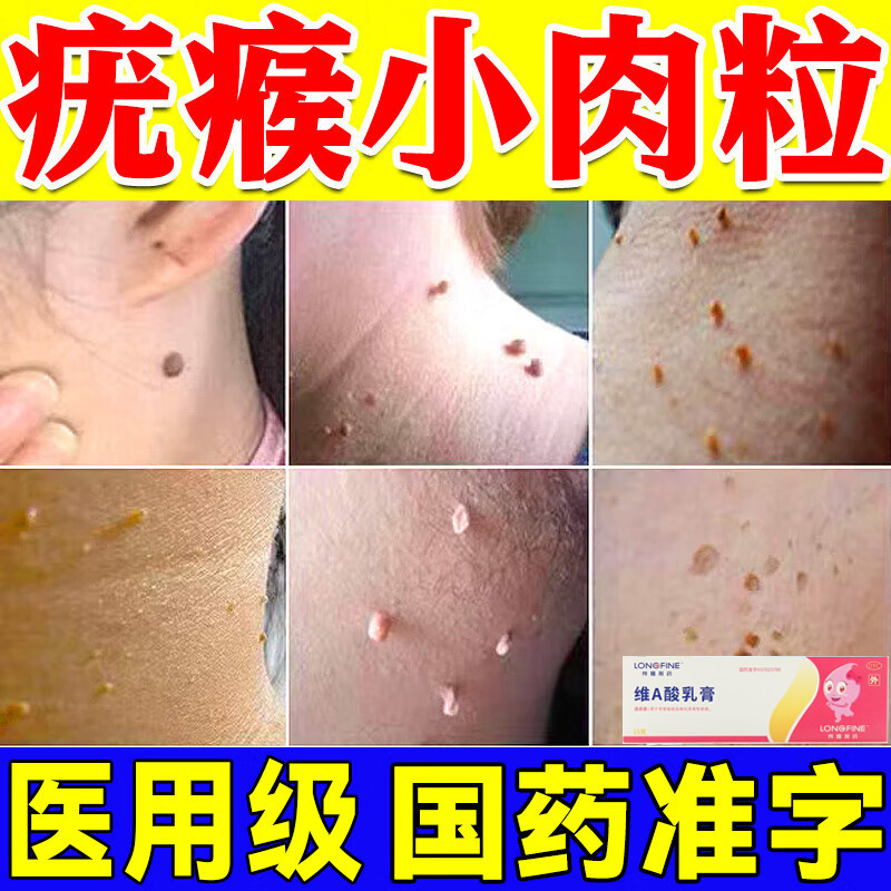 扁平疣脖子肉粒专用药去疣灵扁平疣面部脖子瘊子疣瘊小肉粒专用药