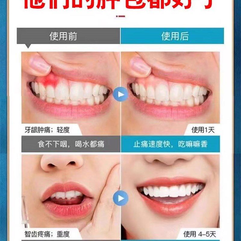 极速牙龈脓包肿包治牙根肿痛上火发炎萎缩鼓包儿童成人牙齿出血喷