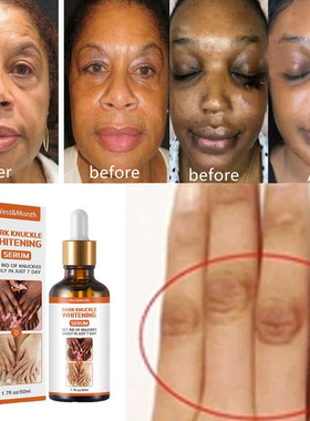 Efficient Whitening Armpit Knuckle Knee Black skin oil精华液