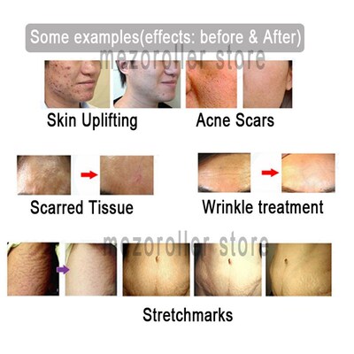 极速50pcs/lot MezoRoller Bayonet Cartridge Replacement For D