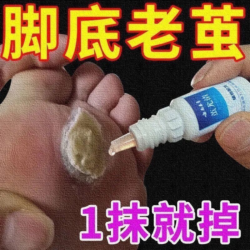 速发去脚死皮老茧脚底去除手上老茧硬皮脚茧软化剂脚趾头关节茧子