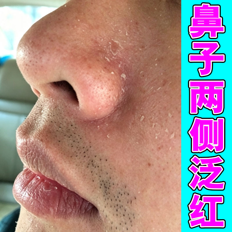 鼻翼发红脱皮鼻翼两边泛红干燥起皮掉皮鼻子痒疼专用
