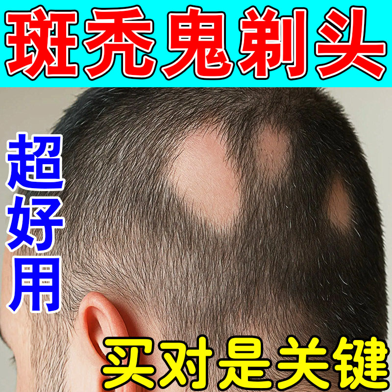 鬼剃头药儿童斑秃脂溢性小块片状皮肤消毒护理（消）