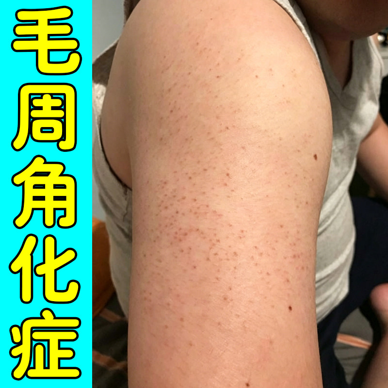 毛周角化症手臂毛囊堵塞长小颗粒疙瘩皮肤粗糙干燥起小黑点修复膏