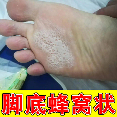 脚底蜂窝小孔脚出汗臭脚气底蜂窝状沙虫症脚底发白脚痒
