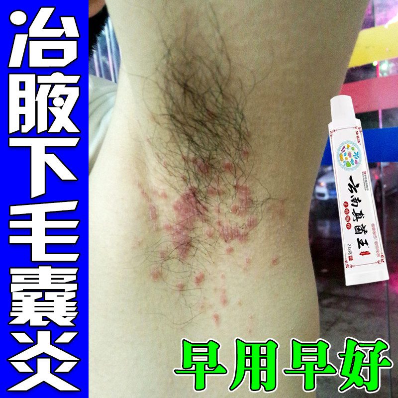 腋下毛囊肿块汗渍长疙瘩发红胳肢窝红腋下淹红马拉色菌药