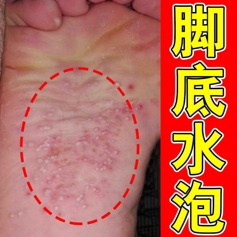 脚底上起小水泡又痒又脱皮脚痒掉皮脚丫痒脚脱皮痒喷雾