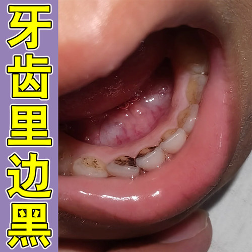 牙斑净牙缝发黑牙根发黑洗牙齿污垢牙黄牙垢牙菌斑牙发黄黑渍