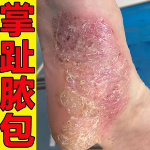 掌趾脓疱病症专用膏掌跖角化症手脚红斑干裂蜕皮角皮症掌跖脓包药