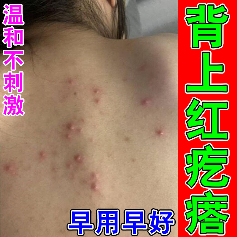 前胸后背长痘痘马拉色菌身上红肿疙瘩长脓包小红点背上痒