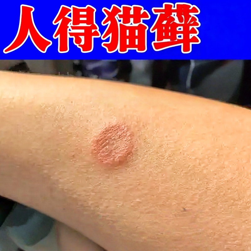 人用猫藓专用膏人得猫藓皮肤痒感染真菌长红斑湿止诊痒软膏