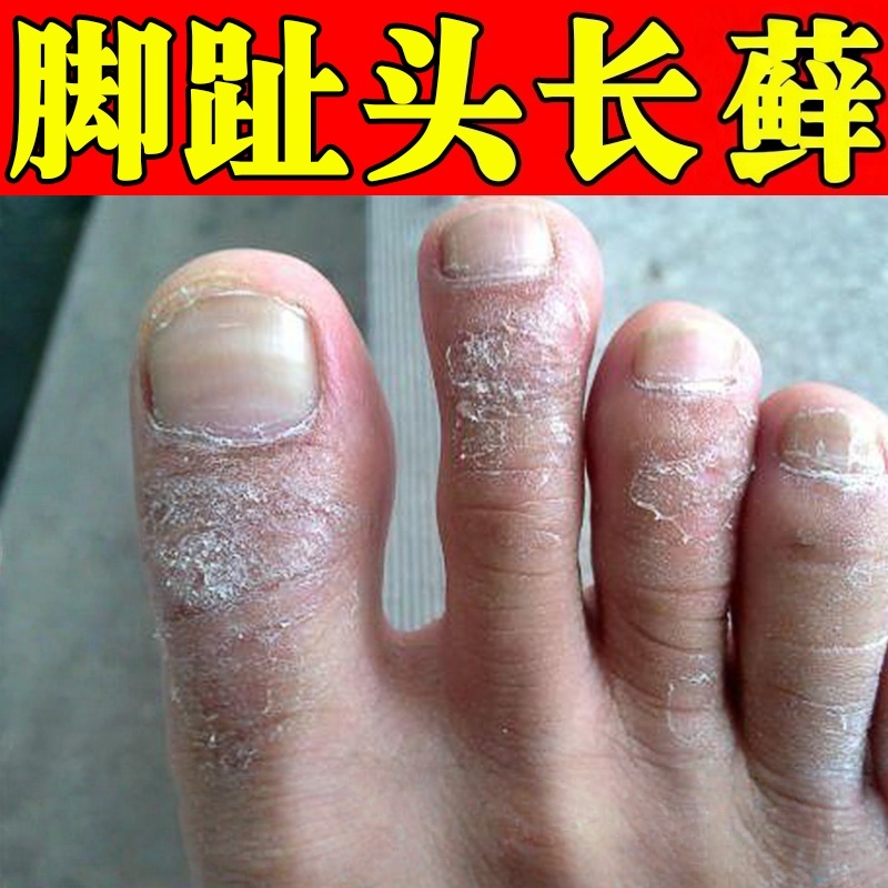 脚趾头上长藓痒去脚趾关节藓皮肤干裂起皮脱皮掉屑神经性皮苔藓炎