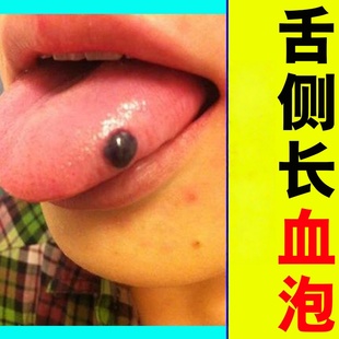 攻舌下囊肿舌侧长血泡舌根疙瘩口腔粘液腺囊肿导管阻塞有硬块喷剂