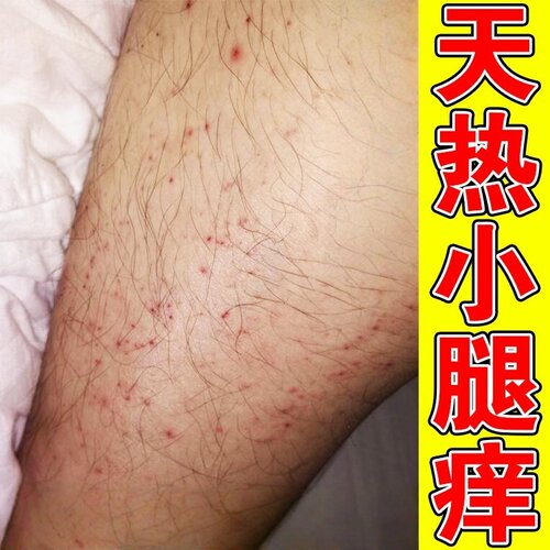 腿痒夏天天气热腿痒腿上长红点皮肤干燥起皮湿抑膏诊