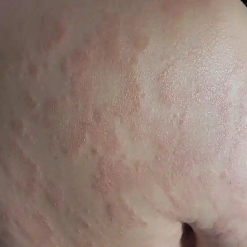 玫瑰糠/诊皮肤红色斑块花班玫瑰/诊湿/皮痒专用菌膏