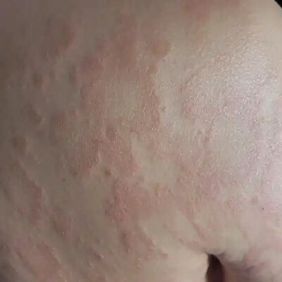 玫瑰糠/诊皮肤红色斑块花班玫瑰/诊湿/皮痒专用菌膏