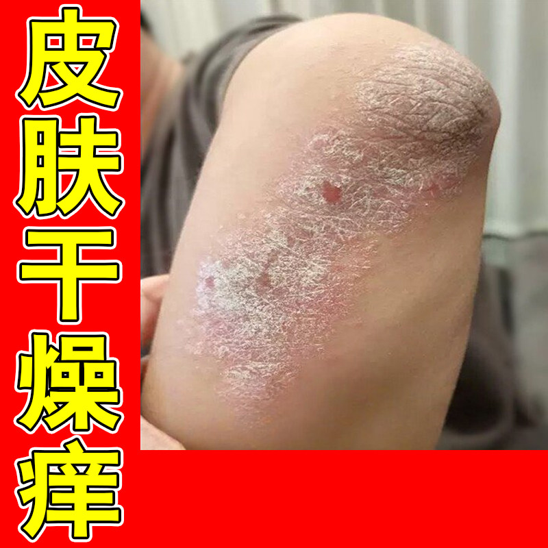 神经/性/皮/痒胳膊起干皮痒中医外用膏无激素痒湿（/真菌诊