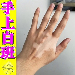 手上白班膏消脸上长白班专用遮盖液外用黑色素生长软膏