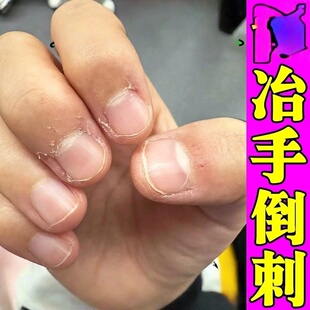 指甲修复液受损再生手指倒刺营养油护理去刺神器防儿童手上干裂脱