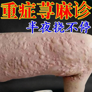 寻麻过敏痒身上起风团疙瘩浑身痒过敏皮病肤腿痒膏