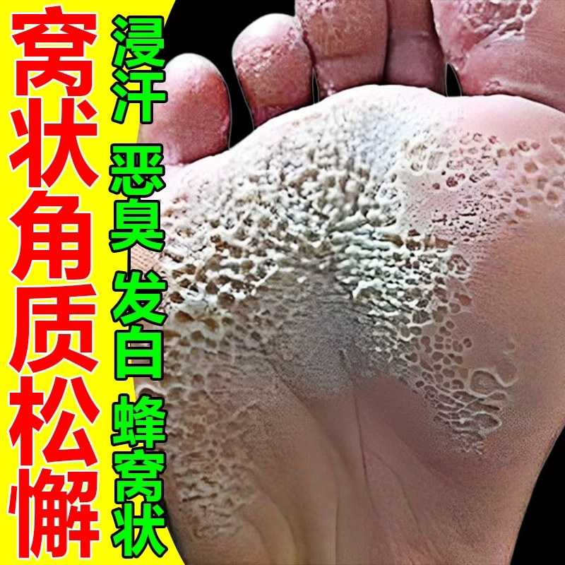 窝状角质松解症脚底起泡蜂窝状沙虫脚脚出汗臭脚止汗止软膏痒