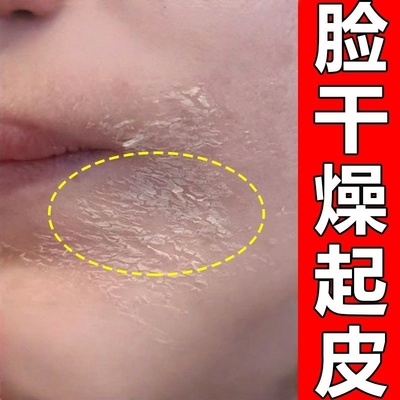 脸干燥起皮有碎屑嘴角下巴鼻子皮肤红痒男士女士修复滋润保湿面霜
