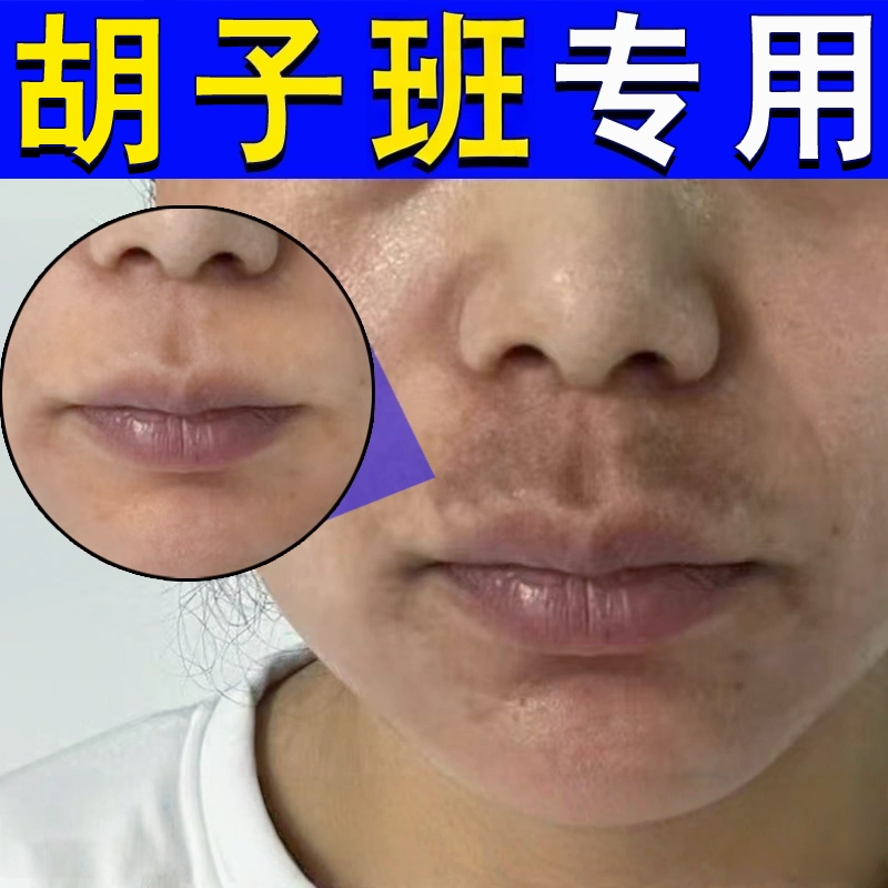 祛胡子斑改善唇周黑色素沉淀淡化嘴角黑暗沉黑斑去死皮唇纹专用膏