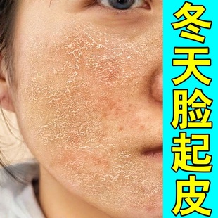 脸干燥起皮有碎屑修复滋润霜换季脸部爆干皮脱皮掉皮发痒皮肤粗糙
