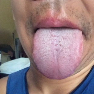 舌苔白厚舌头裂纹两边有齿痕调理儿童口臭干苦口腔异味脾胃健湿气