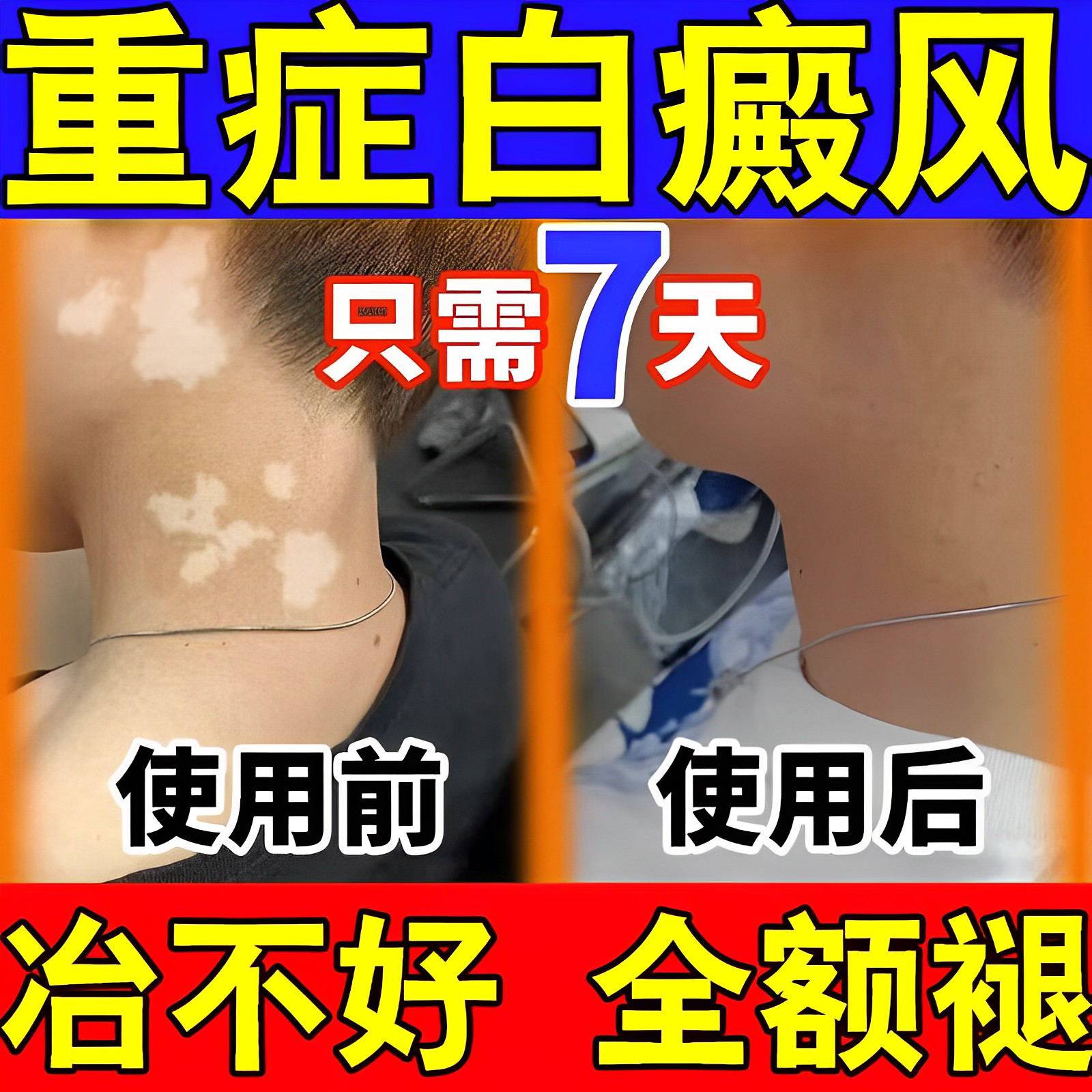 日本补骨脂酊白斑癜风外用促黑色素生长药遮盖液消白软膏正品神器