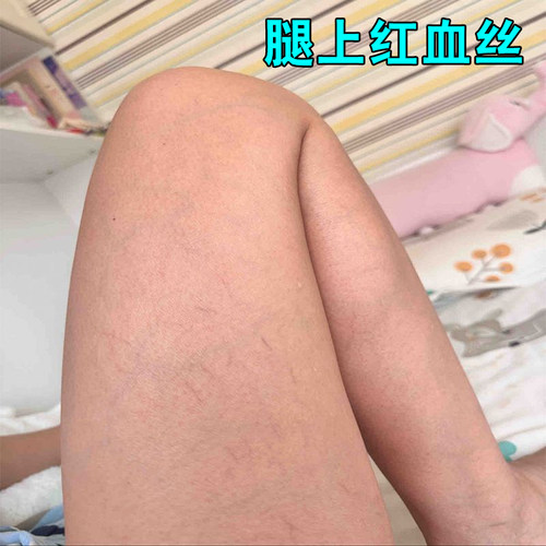 蚯蚓腿膏腿上有血管变紫盘曲凸出青筋红血丝水肿抽筋刺痛腿酸困麻