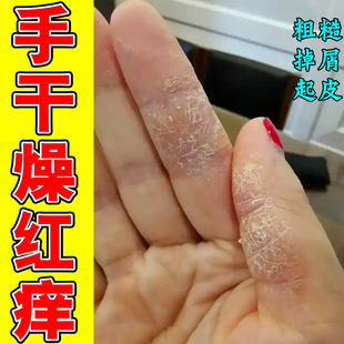 手指关节皮肤增厚手上长硬疙瘩手脱皮干裂手干裂痒掉皮痒