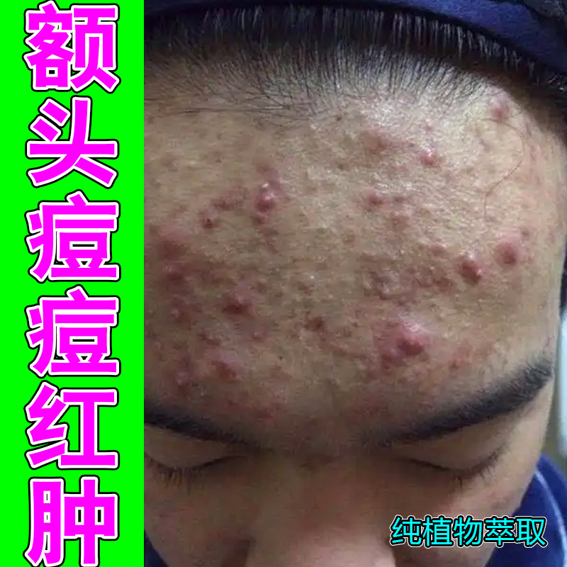 额头痘痘红肿过敏粗糙上火熬夜痘下巴痘青春痘男女通用草本修护药