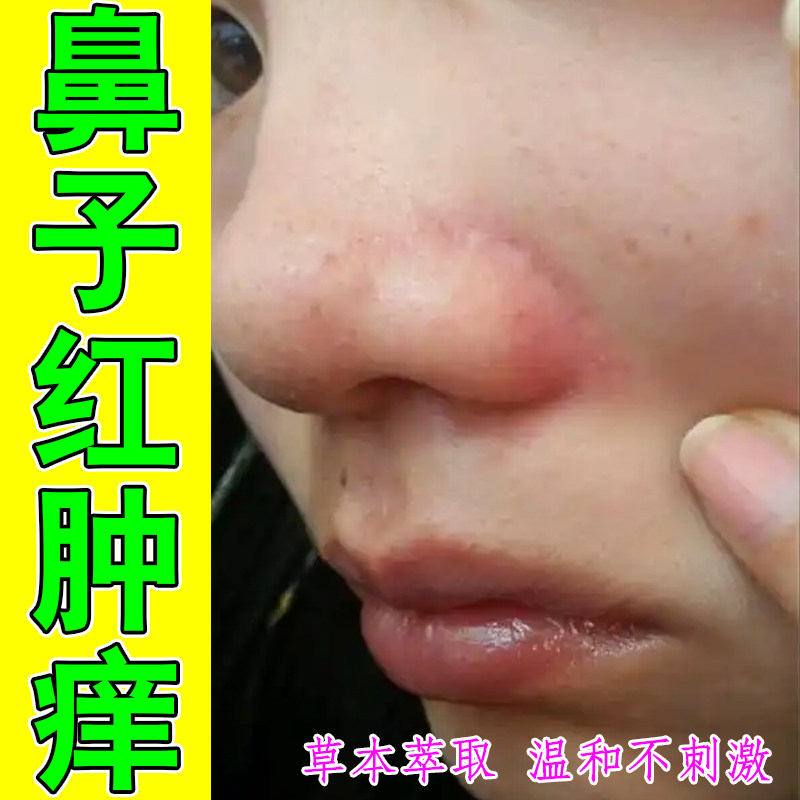 鼻子红肿痒掉屑脱皮起疙瘩痒红鼻头脂溢性酒糟鼻专用修护男女通用