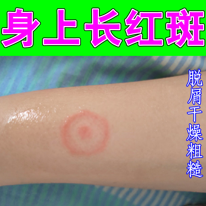 肌肤生出圈形印记局部表层结薄痂阵发性发痒胸腹肢体干斑粗糙肤质