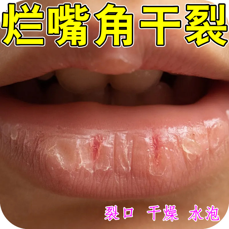 嘴角水疱口唇药儿童成人专用软膏嘴巴上火起泡烂红肿修复羊胡子疮