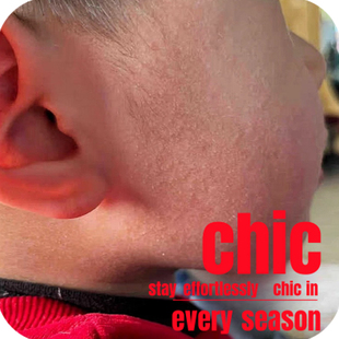 毛囊红斑黑变病脸上小颗粒红褐色斑片毛周角化脸颊两侧密集小疙瘩