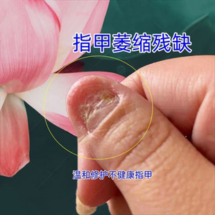 大拇指指甲盖表面凹凸不平横纹甲板变软下陷指甲修复护理