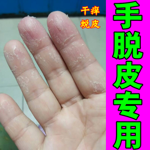 冶疗手脱皮的药膏手指上起皮干燥脚粗糙掉皮足底皮肤裂开